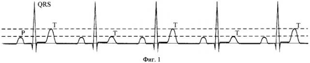 Способ выявления альтернаций т-зубца электрокардиосигнала в режиме реального времени и устройство для его осуществления (патент 2371087)