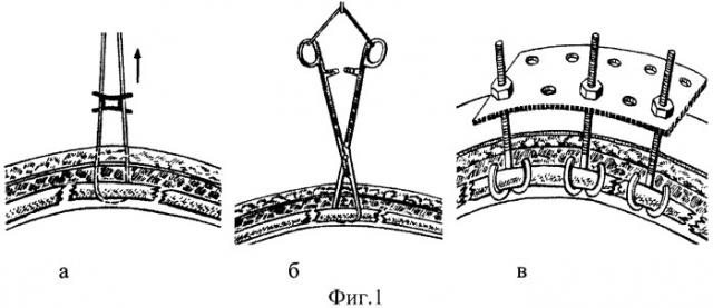 Устройство для фиксации реберной панели (патент 2430699)