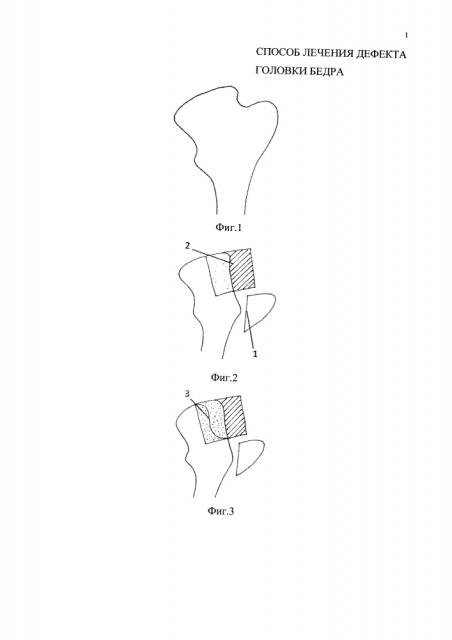 Способ лечения дефекта головки бедра (патент 2637290)