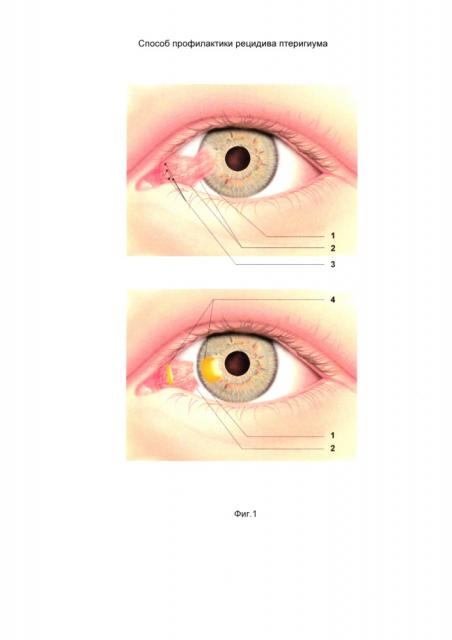 Способ профилактики рецидива птеригиума (патент 2646125)
