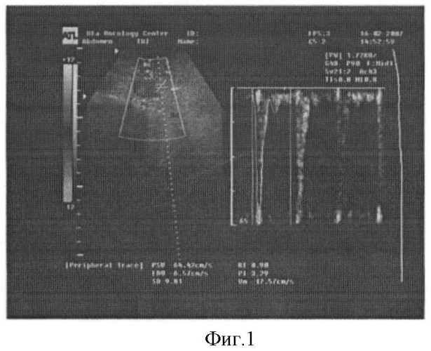 Способ оценки кровотока в нижней брыжеечной артерии методом триплексного сканирования у больных колоректальным раком (патент 2400144)