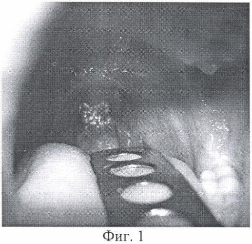 Способ лазирования миндаликового ложа после инструментальной тонзиллэктомии (патент 2377036)