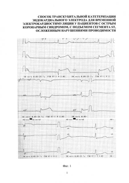Способ катетеризации сердца для установки эндокардиального электрода для временной электрокардиостимуляции у пациентов с острым коронарным синдромом, с подъемом сегмента st, осложенным нарушениями проводимости (варианты) (патент 2594243)