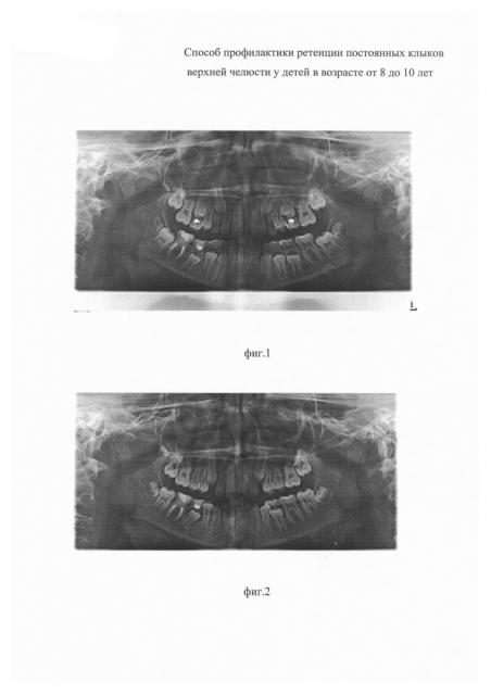 Способ профилактики ретенции постоянных клыков верхней челюсти у детей в возрасте от 8 до 10 лет (патент 2633479)