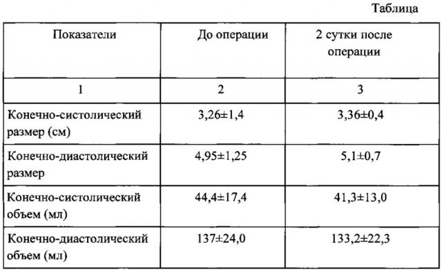 Способ имплантации каркасных протезов клапанов сердца в аортальную позицию при одномоментном протезировании митрального и аортального клапанов (патент 2626318)