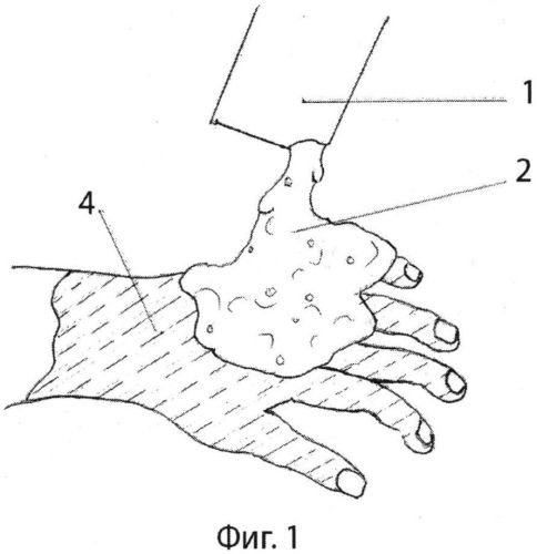 Способ лечения ожогов кисти и профилактики послеожоговых рубцовых деформаций и синдактилий (патент 2559731)