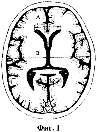 Способ прогнозирования дислокации головного мозга при его компрессии (патент 2433782)