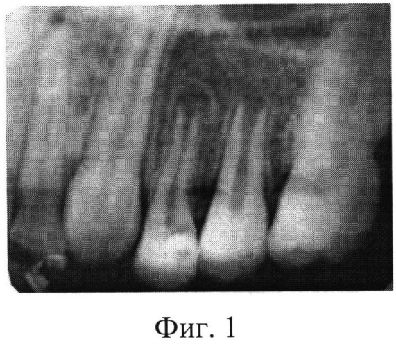 Способ лечения хронического фиброзного пульпита постоянных зубов с несформированными корнями (патент 2566202)
