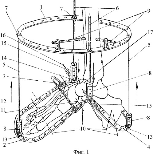 Аппарат внешней фиксации для лечения полой деформации стопы (патент 2366374)
