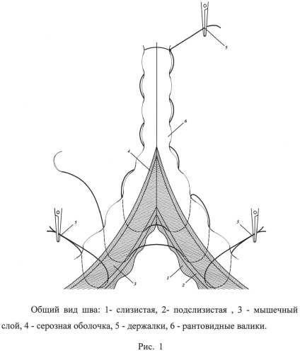 Способ наложения однорядного кишечного шва э.р. тимбакова (патент 2530489)