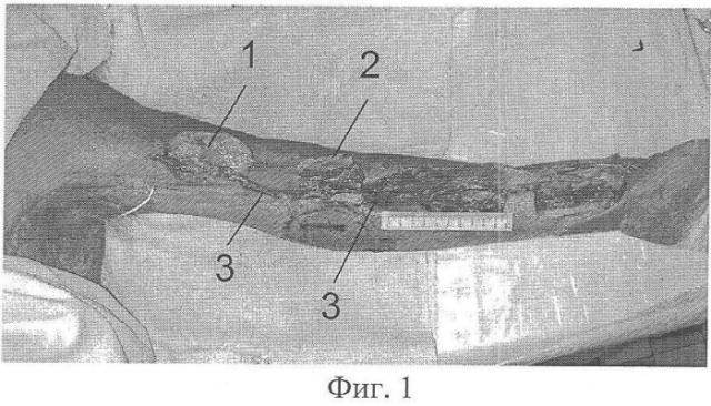 Способ одномоментной несвободной костной аутопластики при дефектах и ложных суставах обеих костей предплечья (патент 2360632)