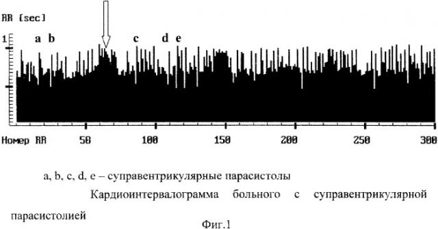 Способ диагностики нарушений ритма и проводимости сердца у детей посредством пробы с компрессией области желчного пузыря (патент 2328211)