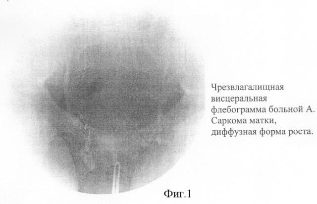 Способ диагностики саркомы матки (патент 2281691)