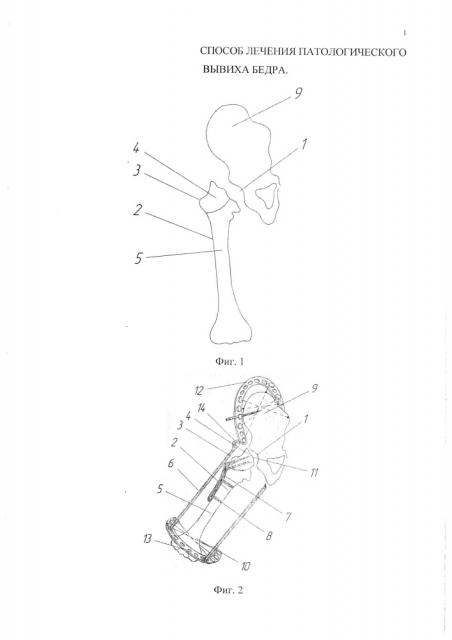 Способ лечения патологического вывиха бедра (патент 2611884)