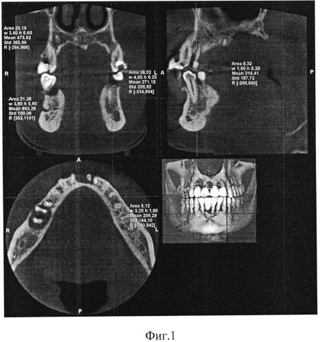 Способ восстановления тканей зубочелюстной системы (патент 2551312)