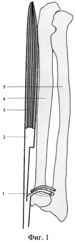 Способ оперативного анатомо-функционального восстановления лучезапястного сустава при повреждении лучевой кости (патент 2537780)