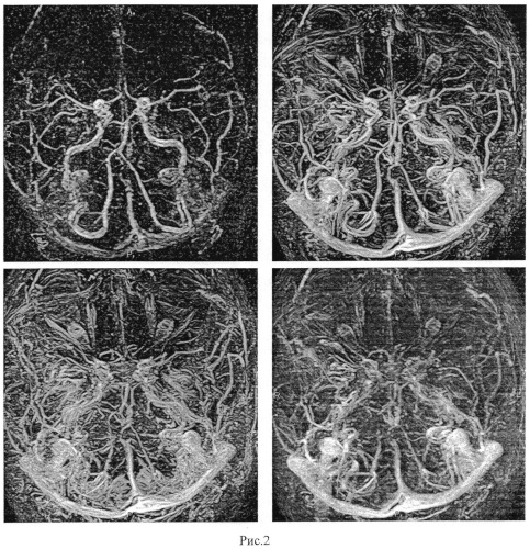 Способ контрастированной магнитно-резонансной ангиографии сосудов головного мозга (патент 2546092)