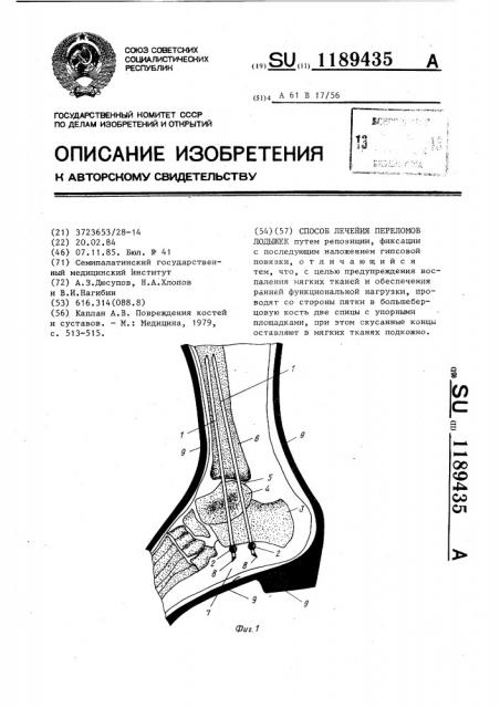 Способ лечения переломов лодыжек (патент 1189435)