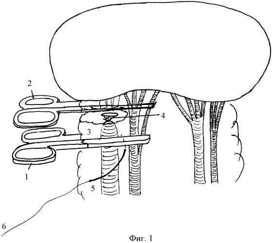 Способ лигирования удвоенной почечной ножки в условиях склерозирующего педункулита (патент 2377956)