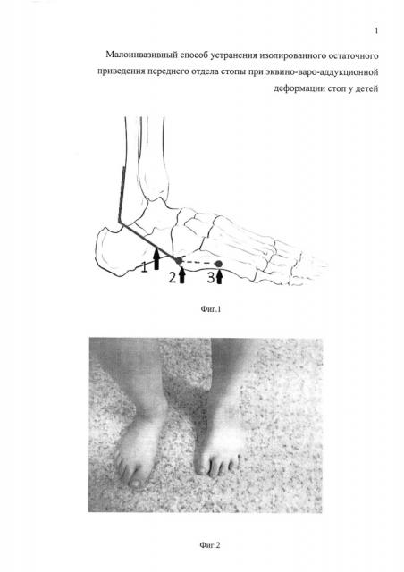 Малоинвазивный способ устранения изолированного остаточного приведения переднего отдела стопы при эквино-варо-аддукционной деформации стоп у детей (патент 2614215)