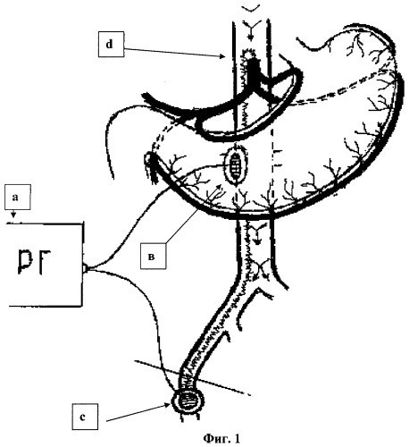 Способ реоартериогастрографии (патент 2316998)