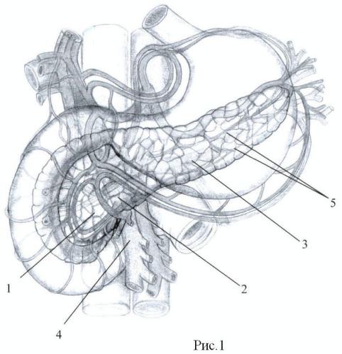 Способ поперечного пересечения поджелудочной железы (патент 2476162)