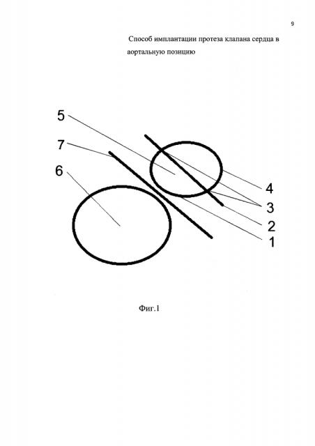 Способ имплантации протеза клапана сердца в аортальную позицию (патент 2622598)