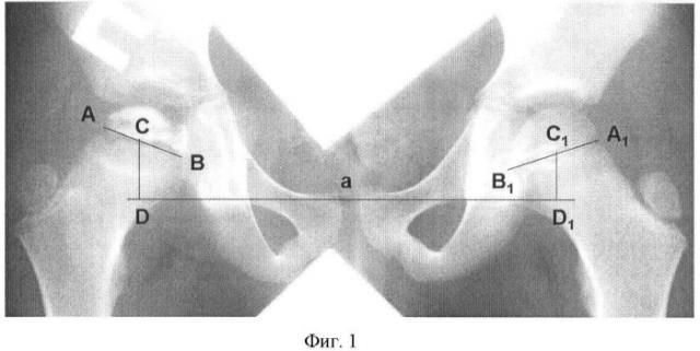 Способ оценки подвывиха головки бедра при болезни легг-кальве-пертеса (патент 2436509)
