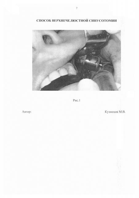 Способ верхнечелюстной синусотомии (патент 2647610)