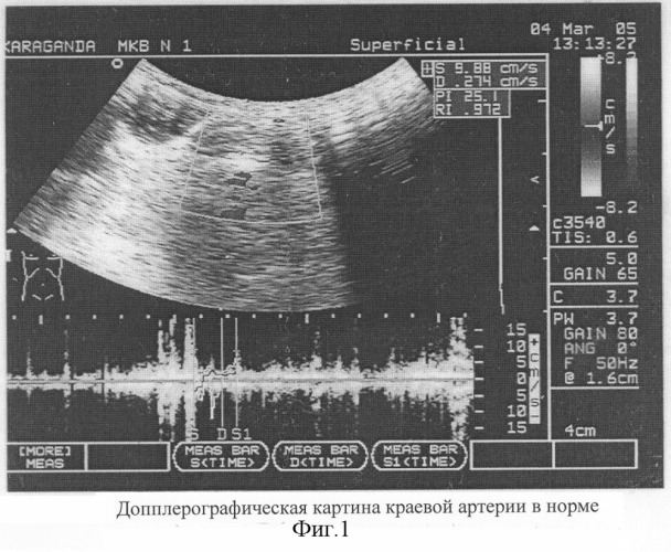 Способ оценки жизнеспособности ободочной кишки (патент 2295293)