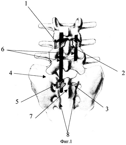 Способ инструментальной фиксации пояснично-крестцового отдела при воспалительных заболеваниях позвоночника (патент 2271165)