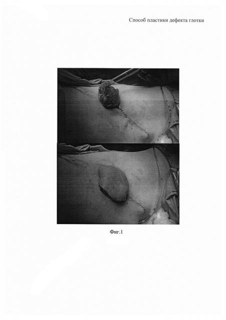 Способ пластики дефекта глотки (патент 2610828)