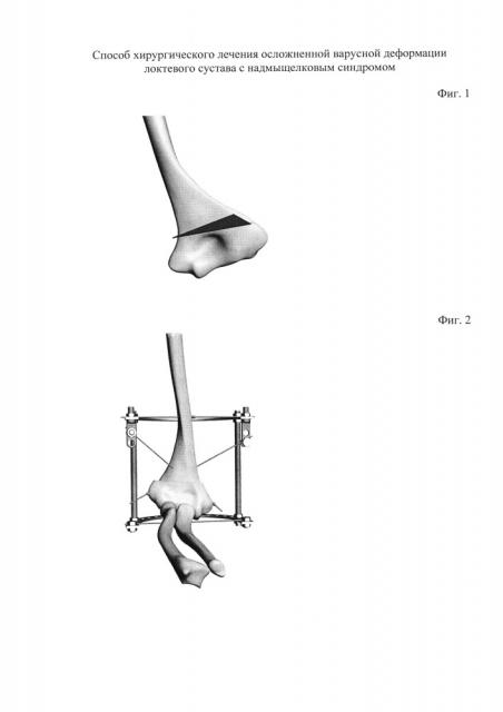 Способ хирургического лечения осложненной варусной деформации локтевого сустава с надмыщелковым синдромом (патент 2618082)