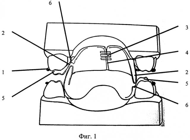 Блочный двухчелюстной ортодонтический аппарат для лечения суставной формы трансверсальной аномалии окклюзии (патент 2570278)