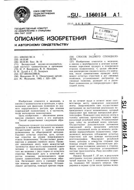 Способ заднего спондилодеза (патент 1560154)