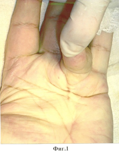 Способ лечения сгибательной контрактуры пальцев кисти (патент 2343867)