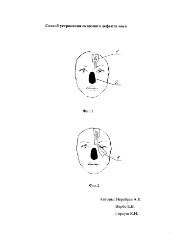 Способ устранения сквозного дефекта носа (патент 2580660)