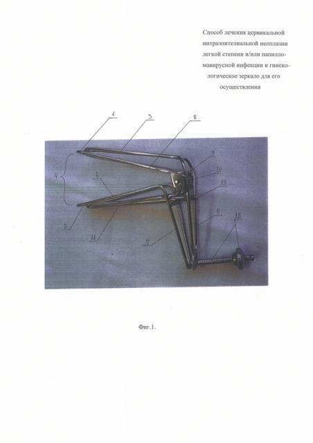 Способ лечения цервикальной интраэпителиальной неоплазии легкой степени и/или папилломавирусной инфекции и гинекологическое зеркало для его осуществления (патент 2623449)
