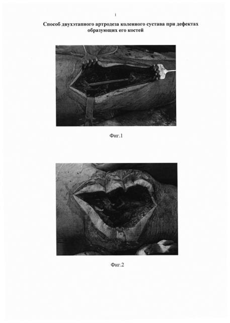 Способ двухэтапного артродеза коленного сустава при дефектах образующих его костей (патент 2648863)