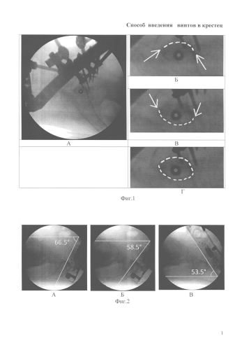 Способ введения винтов в крестец (патент 2584557)