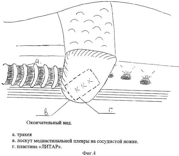 Способ профилактики бронхоплеврального свища после резекции легкого (патент 2300330)