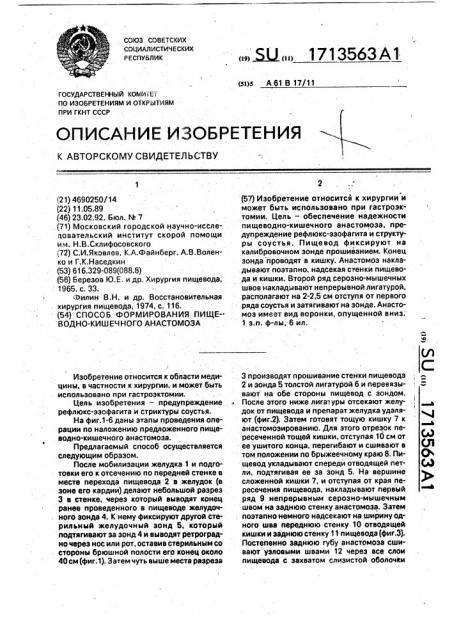 Способ формирования пищеводно-кишечного анастомоза (патент 1713563)