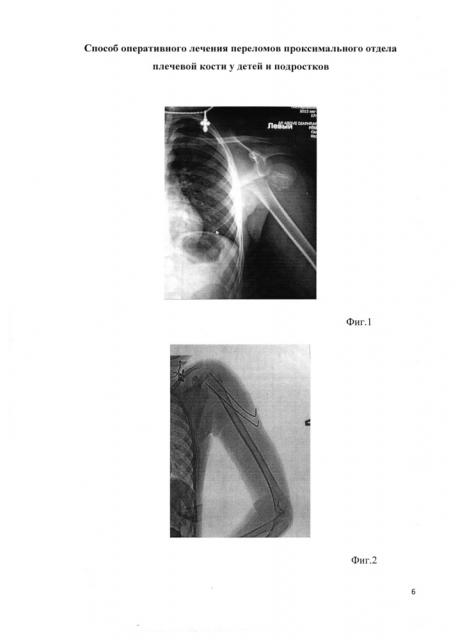 Способ оперативного лечения переломов проксимального отдела плечевой кости у детей и подростков (патент 2609058)