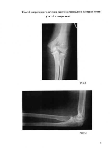 Способ оперативного лечения перелома мыщелка плечевой кости у детей и подростков (патент 2593230)