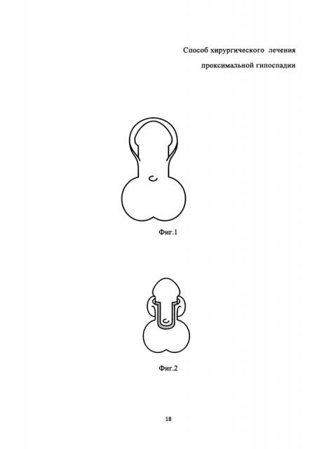 Способ хирургического лечения проксимальной гипоспадии (патент 2665545)