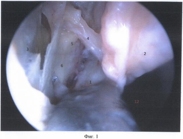 Способ остановки кровотечения из задних отделов полости носа путем селективной каутеризации клиновидно-небной артерии (патент 2489095)
