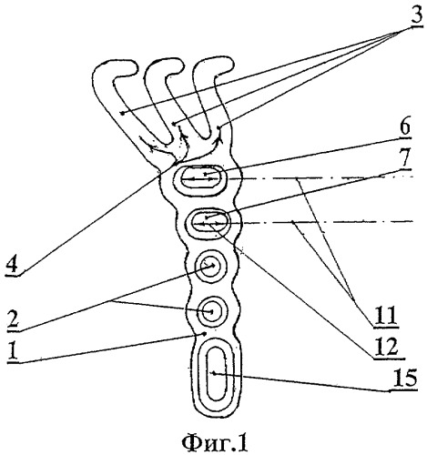 Вильчатая пластинка для остеосинтеза переломов мыщелков большеберцовой кости (патент 2312634)