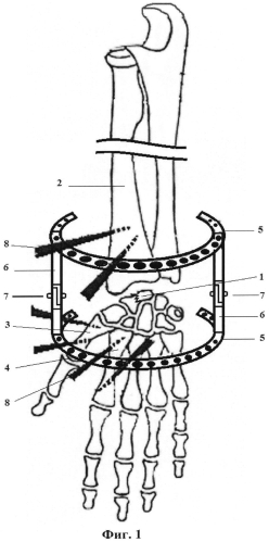 Способ оперативного лечения повреждения ладьевидной кости кисти (патент 2552915)