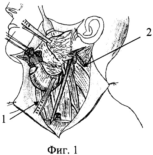 Способ остановки кровотечения из верхнего конца внутренней яремной вены у места выхода из черепа (патент 2331371)