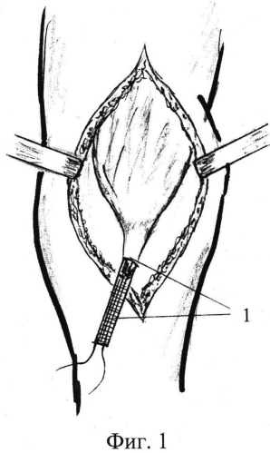 Способ пластики оторванного сухожилия двуглавой мышцы (патент 2552692)